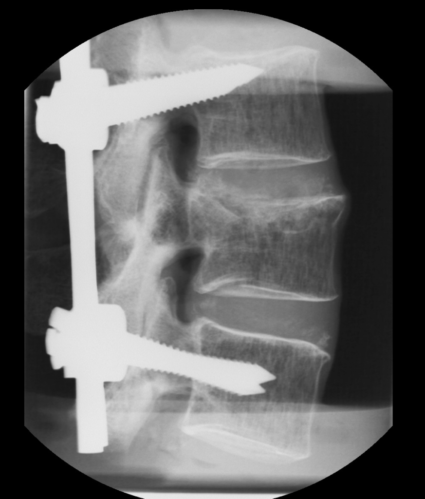 X-ray image of fracture fixation in a human spine