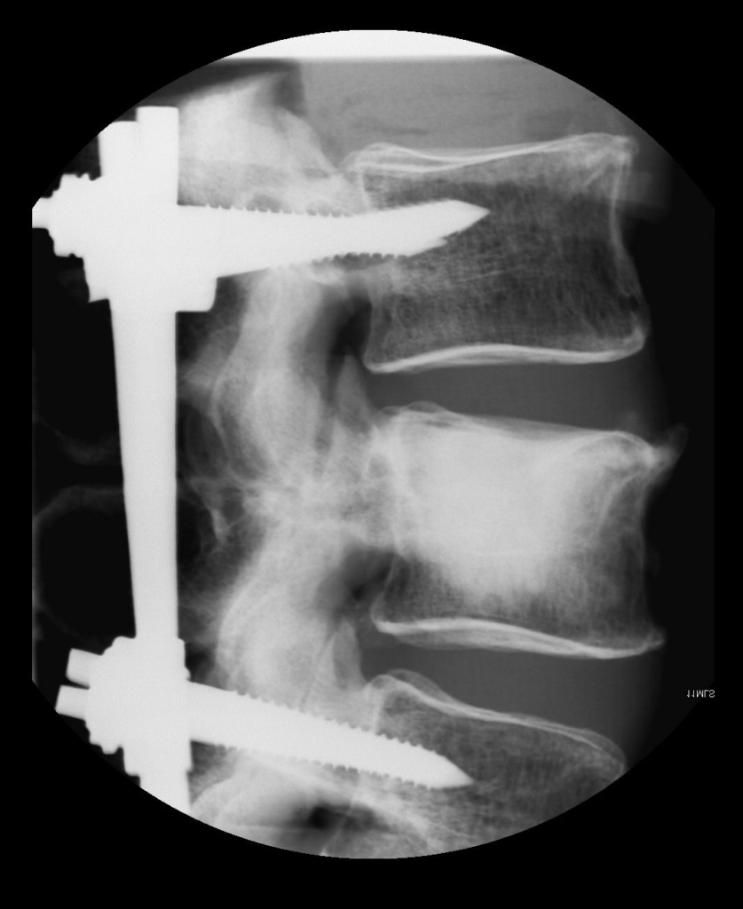 X-ray image of fracture fixation in a human spine